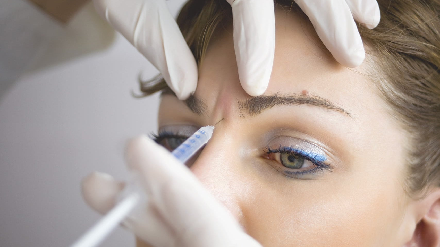 Comment le Botox agit-il sur les rides du lion pour adoucir l’expression sans figer le visage ?