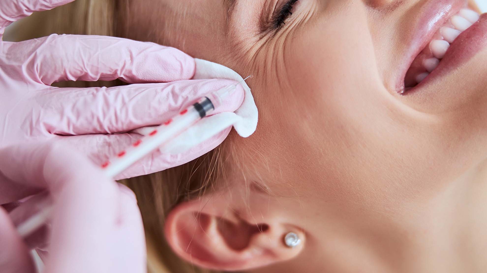 Comment le Botox permet-il de lisser les pattes d’oie tout en respectant l’expressivité du regard ?