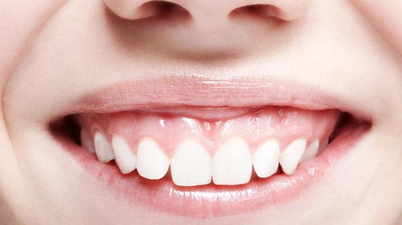 Quels résultats attendre après un traitement du sourire gingival au Botox et combien de temps durent-ils ?