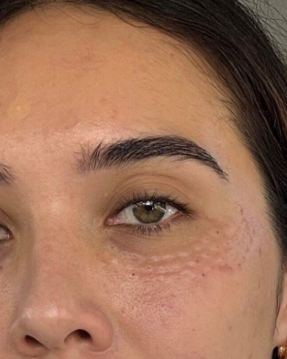 Qu’est-ce que le traitement Salmon Eye et à quoi sert-il pour la qualité de la peau ?