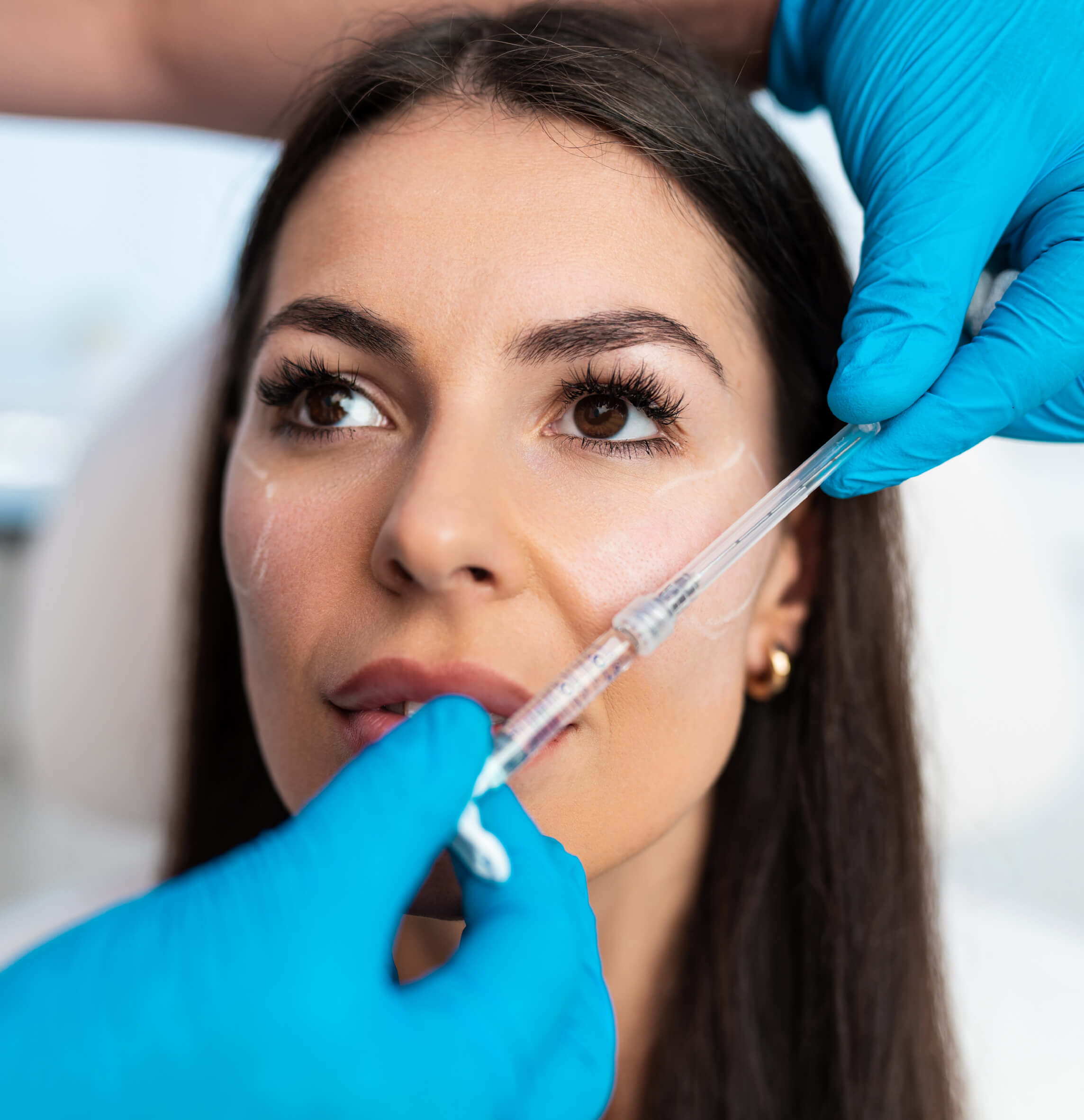 Quels résultats attendre du Sculptra et quelles précautions après le traitement ?