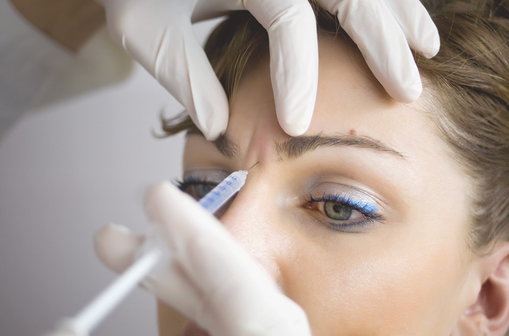 Comment le Botox agit-il sur les rides du lion pour adoucir l’expression sans figer le visage ?