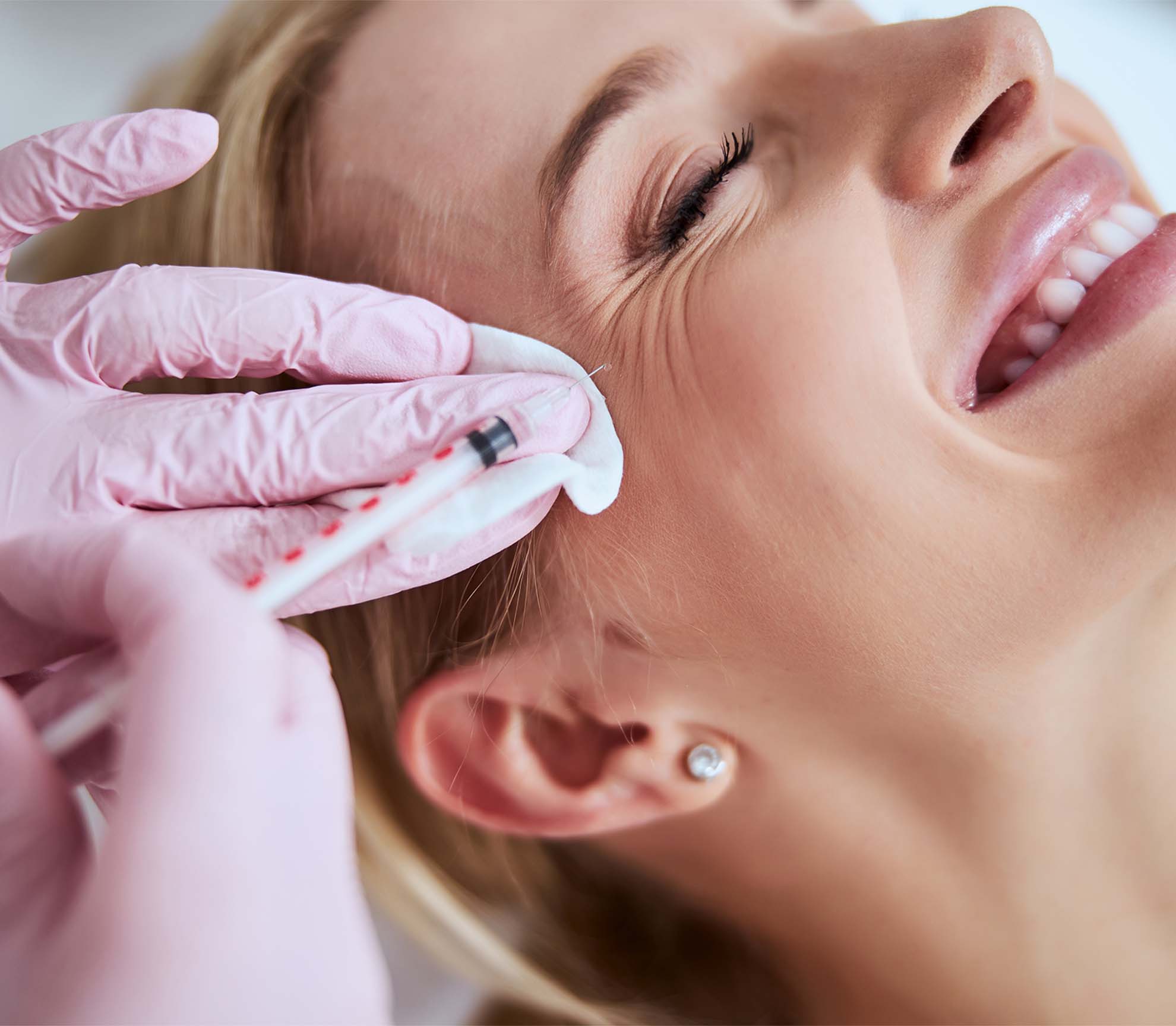 Comment le Botox permet-il de lisser les pattes d’oie tout en respectant l’expressivité du regard ?
