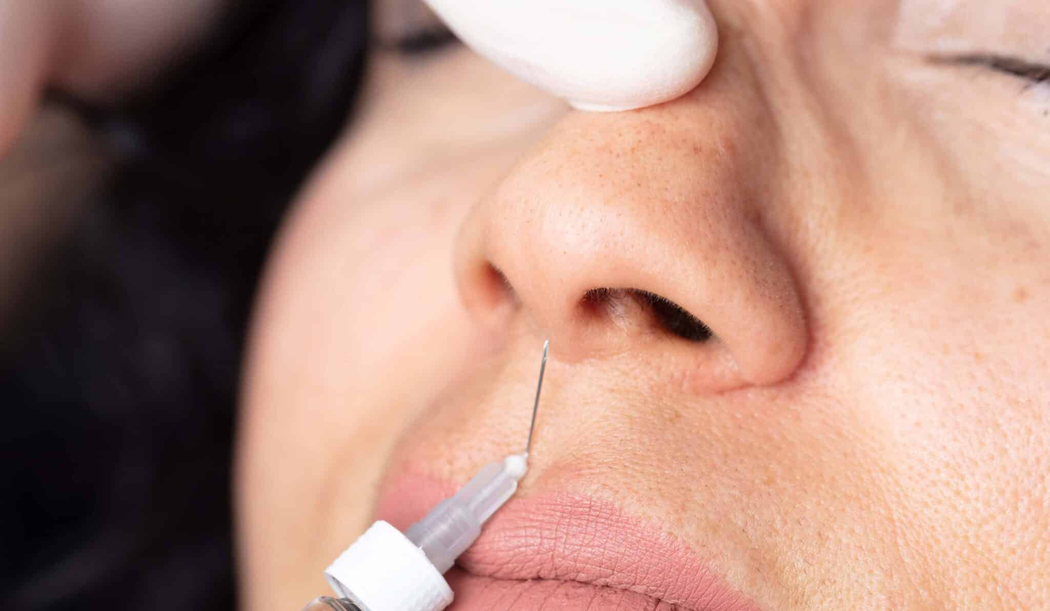 Quels résultats attendre du Botox des narines et combien de temps durent-ils ?