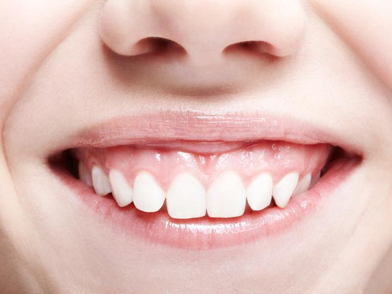 Quels résultats attendre après un traitement du sourire gingival au Botox et combien de temps durent-ils ?