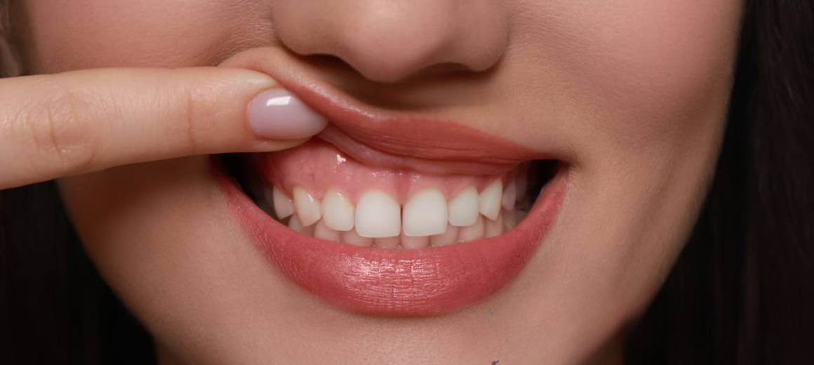 Qu’est-ce qu’un sourire gingival et pourquoi certaines personnes montrent-elles plus leurs gencives en souriant ?