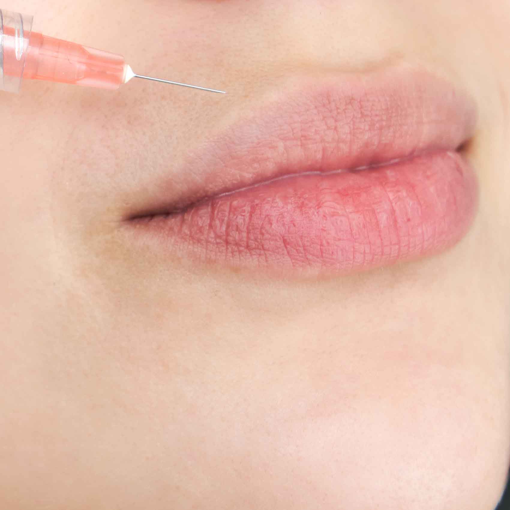 Comment se déroule une séance de Lip Flip au Botox ?