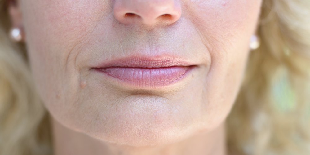 Quels résultats attendre après une injection des sillons nasogéniens et combien de temps durent-ils ?
