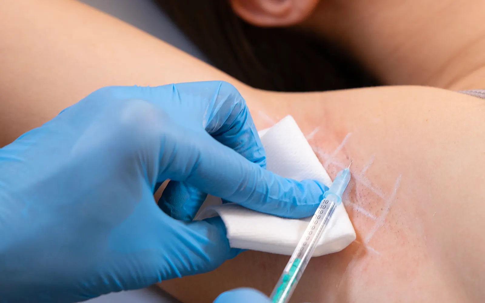 Quels sont les bénéfices à long terme du traitement de la transpiration excessive par Botox ?